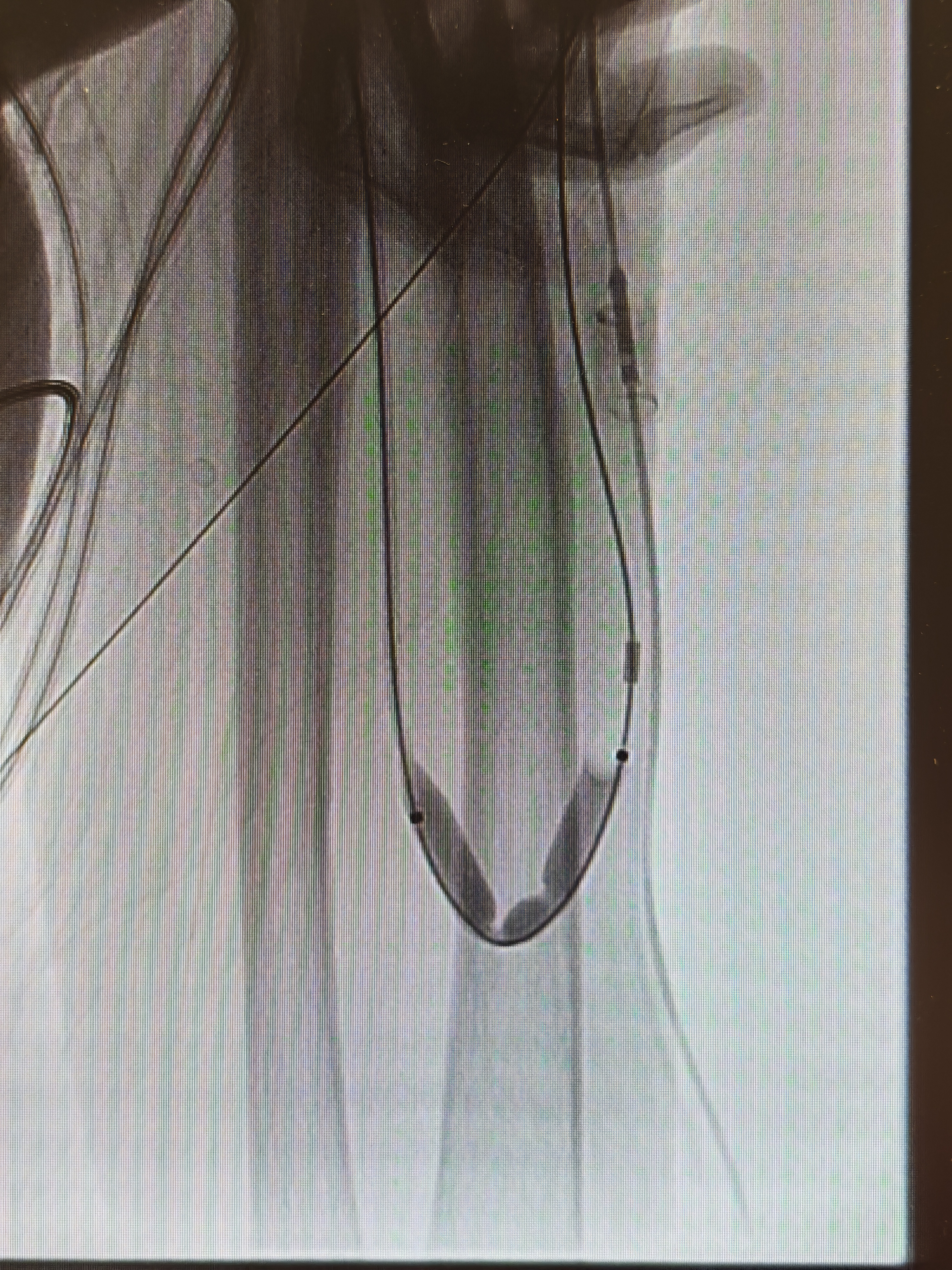 打通「生命线」!四川泰康医院 成功完成复杂血透通路介入再通术