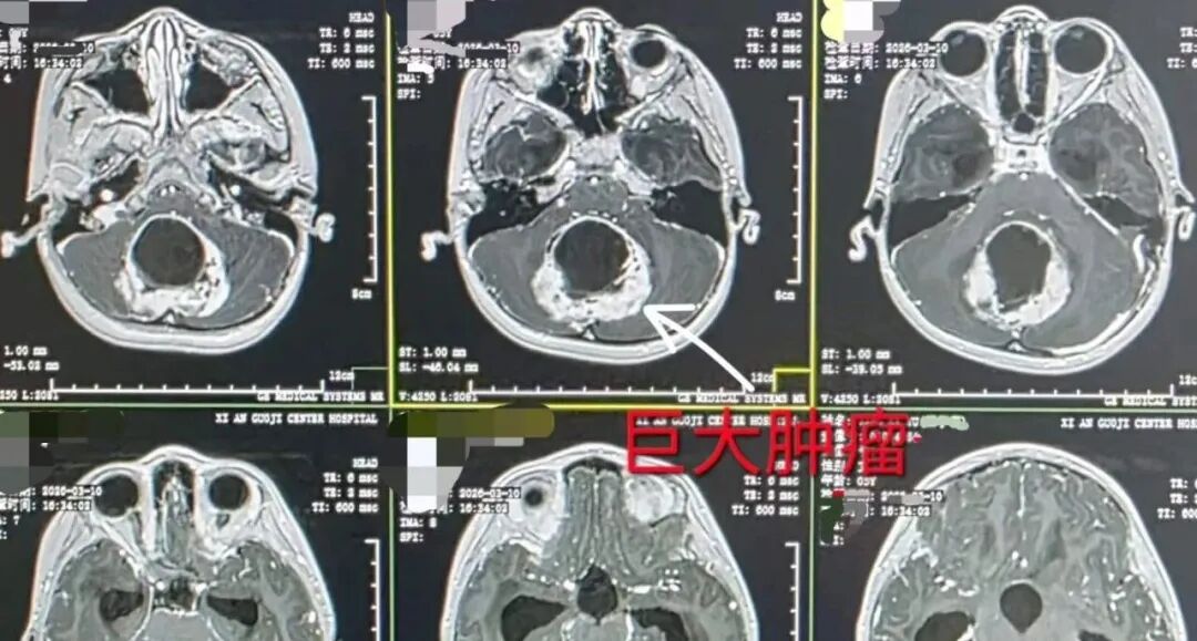 「苹果大」脑瘤压住 5 岁娃命门！小脑被挤 2/3，打个喷嚏就完了…