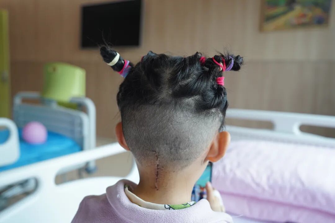 「苹果大」脑瘤压住 5 岁娃命门！小脑被挤 2/3，打个喷嚏就完了…