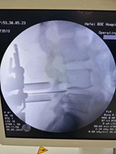 30 年修复万根脊柱，合肥京东方医院骨科刘艺明