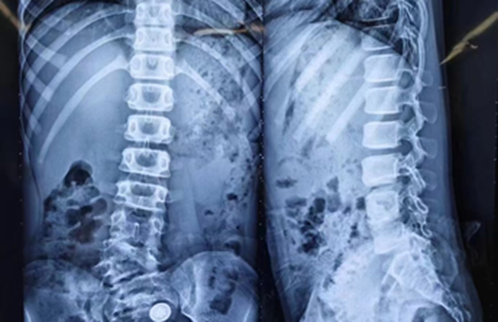 30 年修复万根脊柱，合肥京东方医院骨科刘艺明