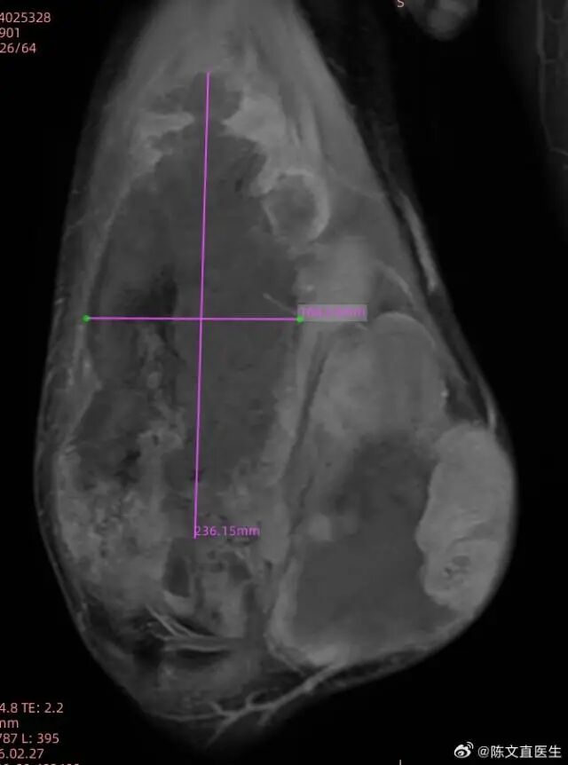 拒截肢!28 cm「巨型」腿部瘤,重庆海扶医院硬核保肢