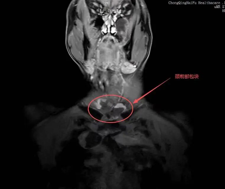 抗脂肪肉瘤 9 年，重庆海扶医院为晚期患者推开一扇窗
