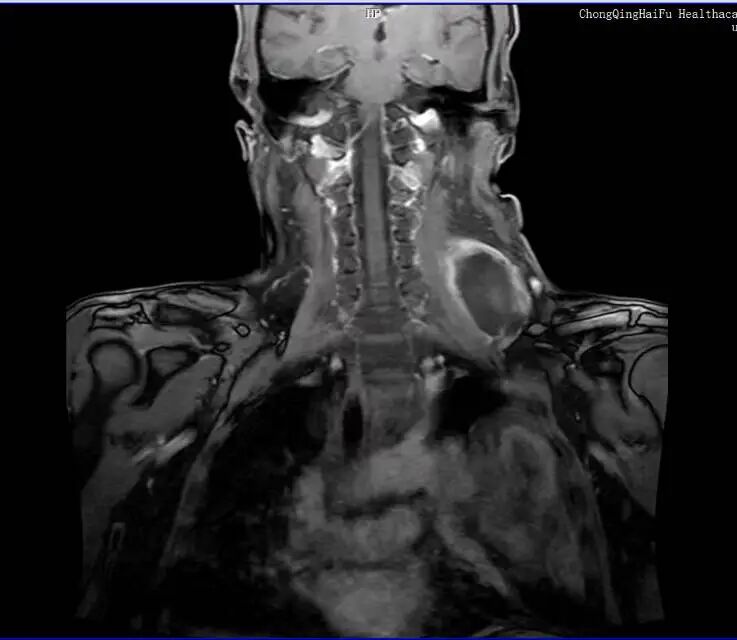 抗脂肪肉瘤 9 年，重庆海扶医院为晚期患者推开一扇窗