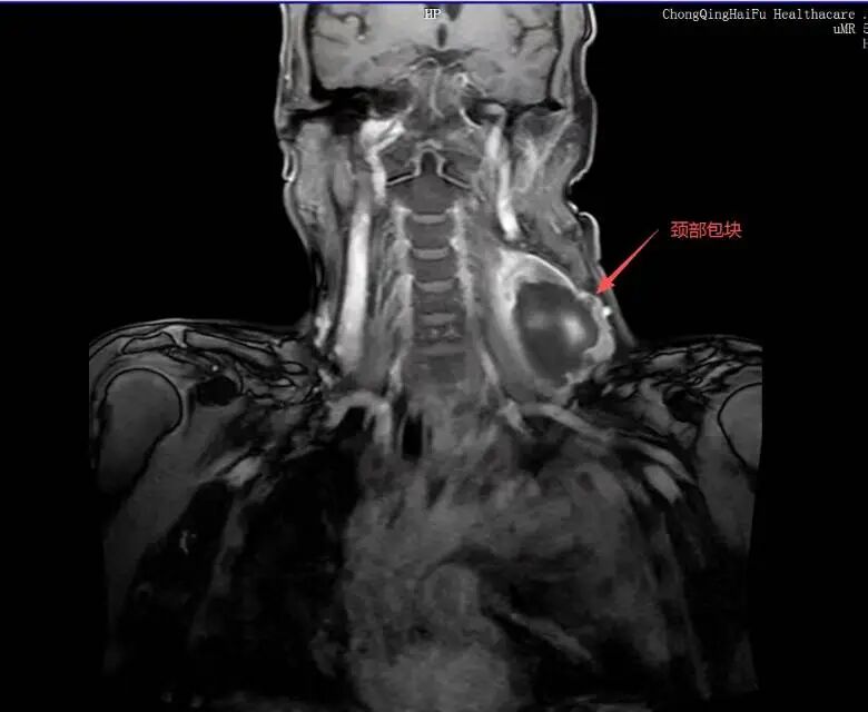 抗脂肪肉瘤 9 年，重庆海扶医院为晚期患者推开一扇窗