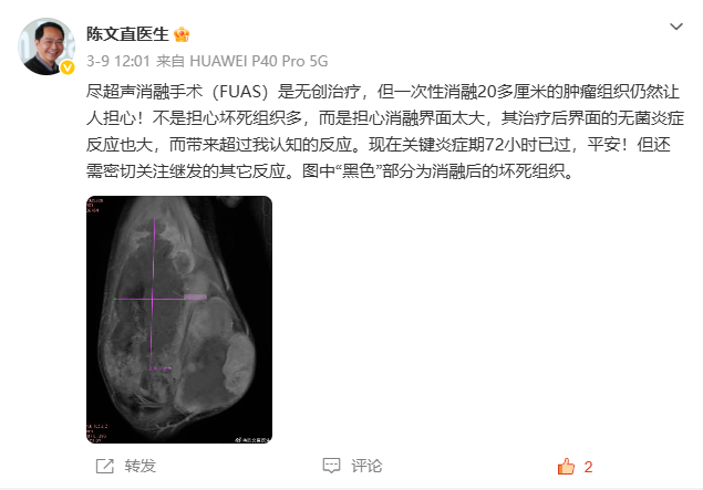 拒截肢!28 cm「巨型」腿部瘤,重庆海扶医院硬核保肢