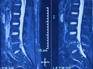 30 年修复万根脊柱，合肥京东方医院骨科刘艺明