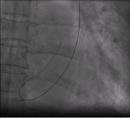 71 岁老人心脏停搏 5.16 秒，血管还「长错了」，医生如何破局？