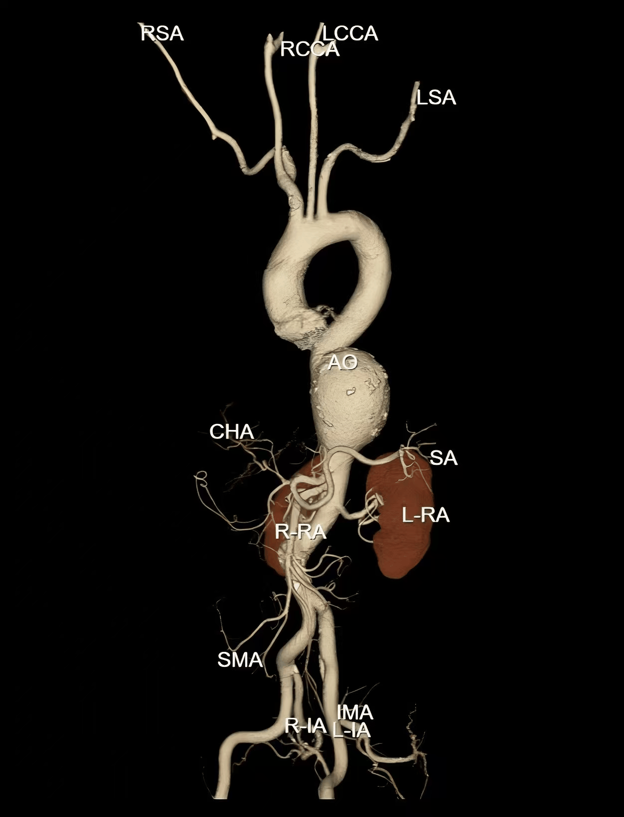 巨大主动脉瘤横跨胸腔、腹腔!武大人民医院血管外科微创「拆弹」同时保住生命「命门」