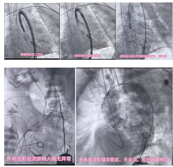 「五重」高危心脏病缠身生命垂危，昆明三博突破挑战高难 TAVR 手术守护「心」门