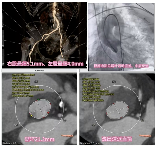 「五重」高危心脏病缠身生命垂危，昆明三博突破挑战高难 TAVR 手术守护「心」门