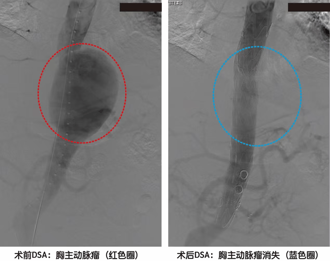 巨大主动脉瘤横跨胸腔、腹腔!武大人民医院血管外科微创「拆弹」同时保住生命「命门」