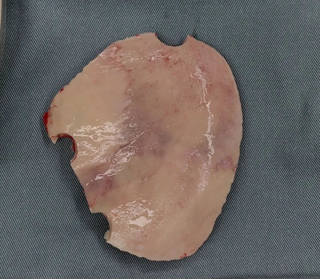 把取下的头骨「装」回去:自体颅骨修补术的临床突破