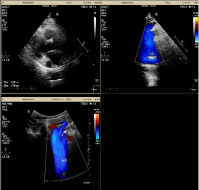 71 岁老人心脏停搏 5.16 秒，血管还「长错了」，医生如何破局？