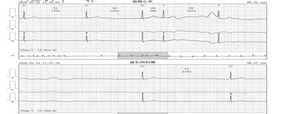 71 岁老人心脏停搏 5.16 秒，血管还「长错了」，医生如何破局？
