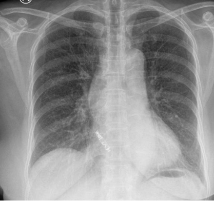 71 岁老人心脏停搏 5.16 秒，血管还「长错了」，医生如何破局？