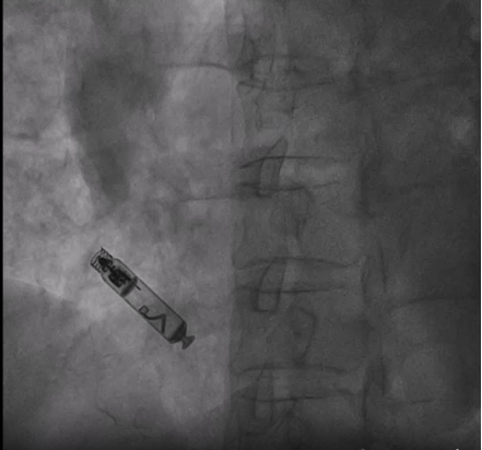 71 岁老人心脏停搏 5.16 秒，血管还「长错了」，医生如何破局？