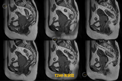 【高尚病例】宫颈癌多模态 MRI 诊断及评估