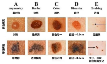 脚底黑斑、指甲黑线:是「小记号」,还是健康警报?