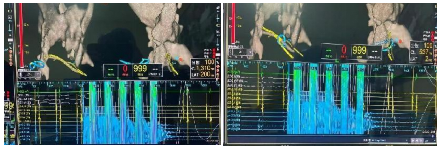 国内首创！南大二附院自主深度镇静下成功实施两例高难度房颤脉冲消融手术