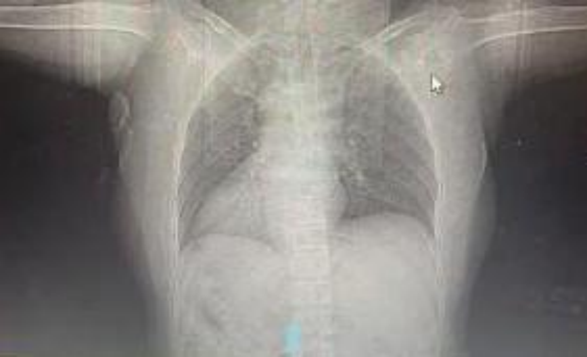 国内首创！南大二附院自主深度镇静下成功实施两例高难度房颤脉冲消融手术