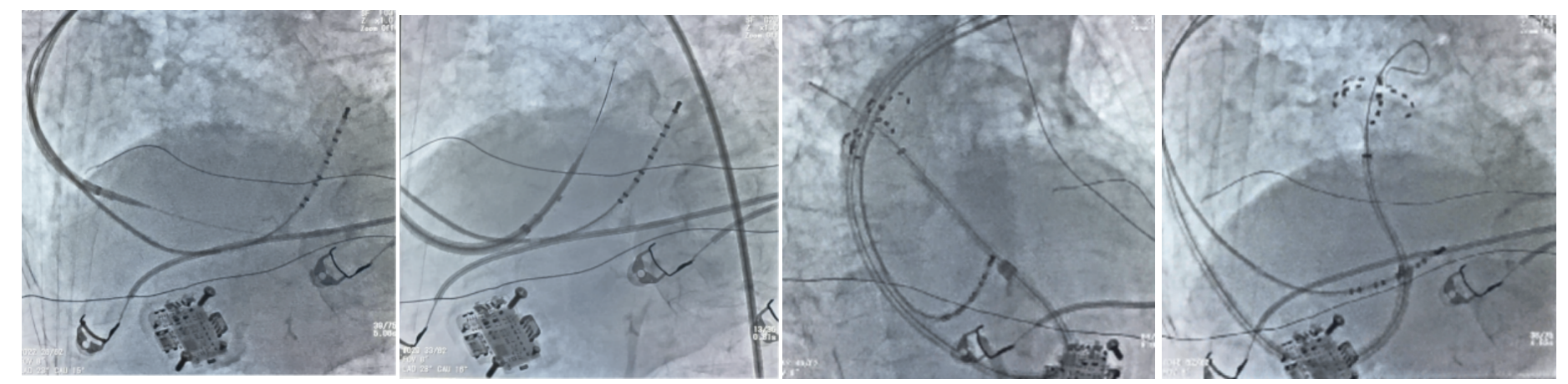 国内首创！南大二附院自主深度镇静下成功实施两例高难度房颤脉冲消融手术