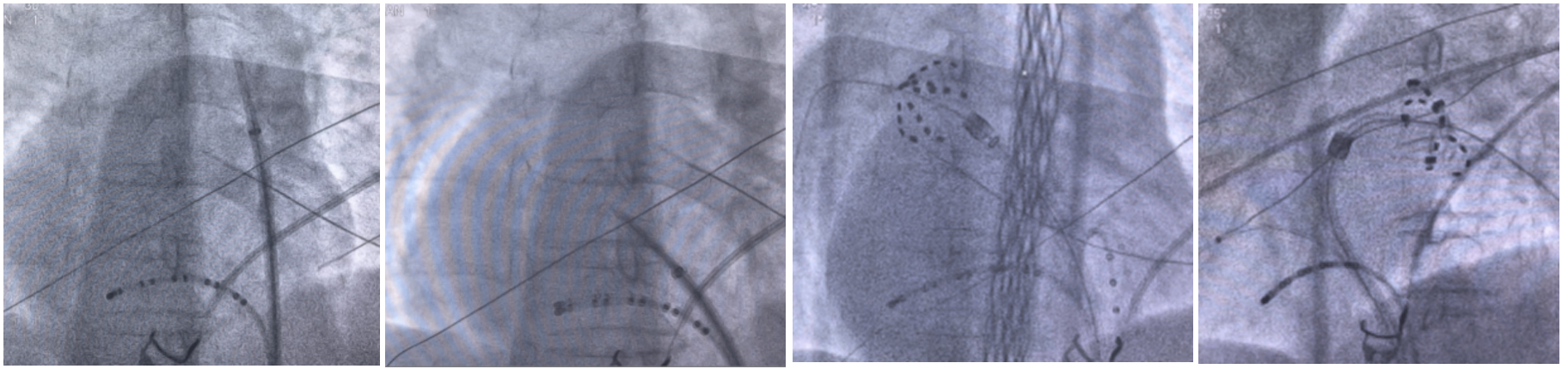 国内首创！南大二附院自主深度镇静下成功实施两例高难度房颤脉冲消融手术