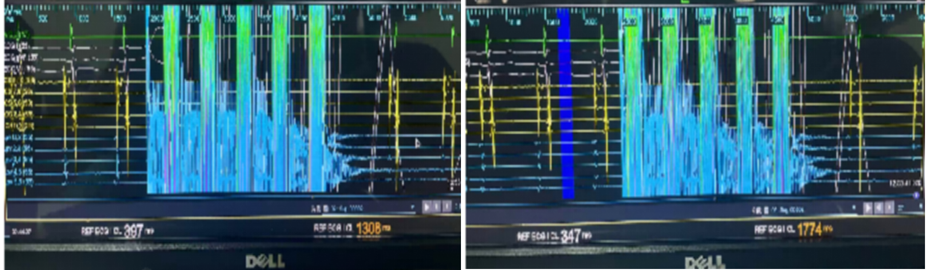 国内首创！南大二附院自主深度镇静下成功实施两例高难度房颤脉冲消融手术