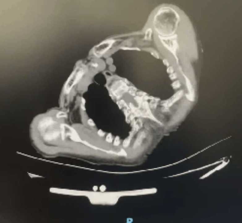 国内首创！南大二附院自主深度镇静下成功实施两例高难度房颤脉冲消融手术