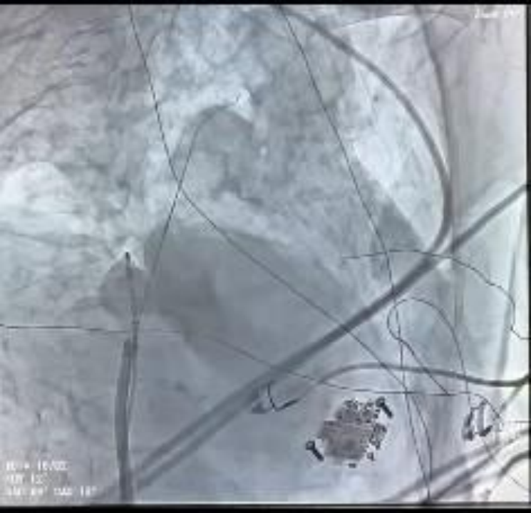 国内首创！南大二附院自主深度镇静下成功实施两例高难度房颤脉冲消融手术