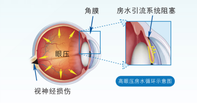 关灯玩手机有什么危害吗？武汉普瑞眼科程旭康提醒注意引发青光眼