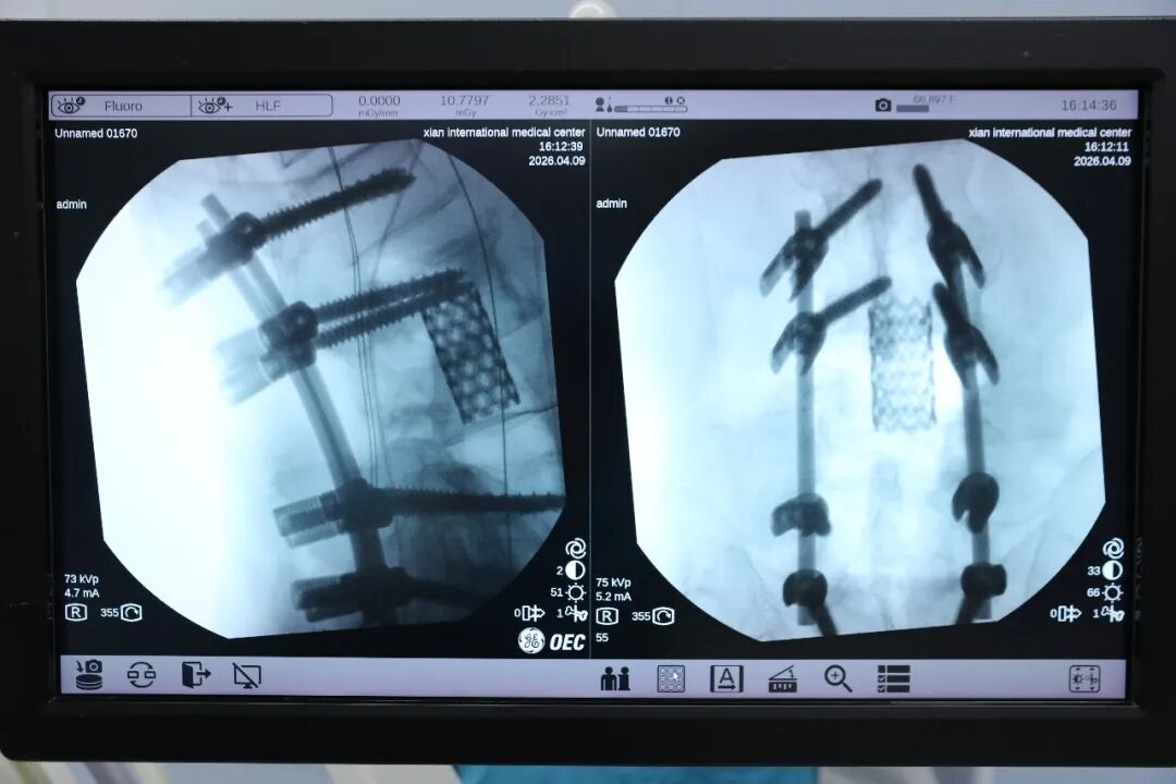 腰痛腿麻，是癌转移？专家一查：竟是比转移更罕见的「元凶」