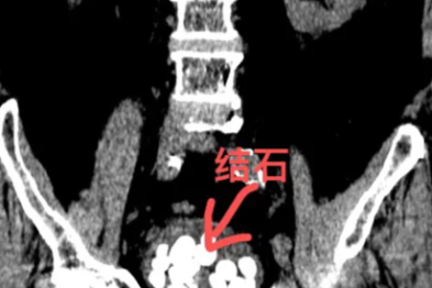 九旬爹爹排尿难 微创取石解顽疾——我院泌尿外科成功为 91 岁高龄患者实施膀胱碎石取石术