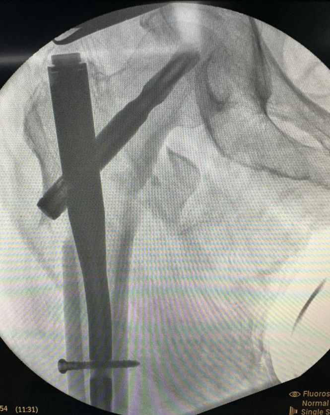4 cm 小切口,成功救治高龄股骨粗隆间骨折患者
