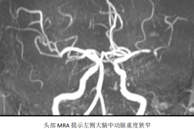 心梗合并脑梗：当治疗「左右为难」，介入手术如何扭转危局？