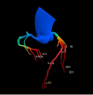科普在线 | 警惕猝死风险！冠脉 CTA，为您的心脏健康「保驾护航」