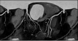 科普在线 | 警惕猝死风险！冠脉 CTA，为您的心脏健康「保驾护航」
