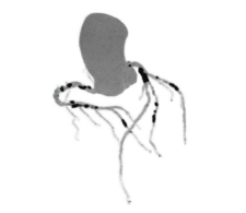 科普在线 | 警惕猝死风险！冠脉 CTA，为您的心脏健康「保驾护航」