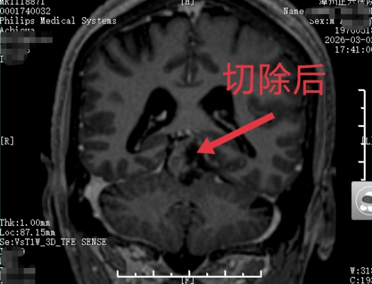 49 岁男子脑部 「禁区」 长瘤,神经外科 Poppen 入路精准亮剑