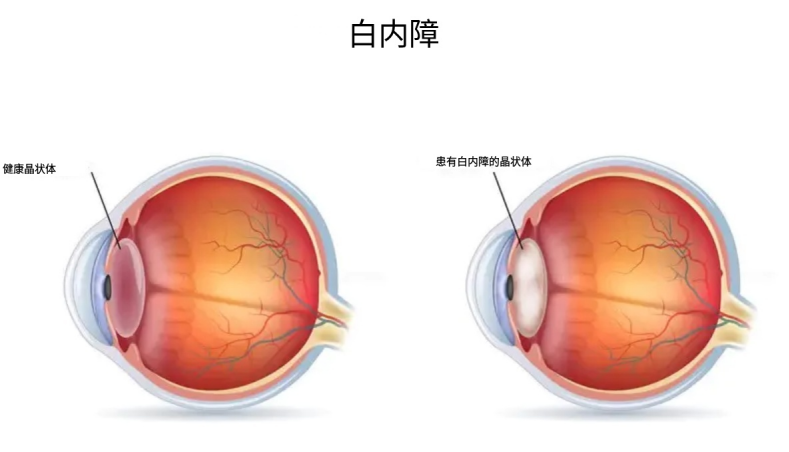 老花镜频繁更换还是看不清？一查原来是......