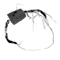 科普在线 | 警惕猝死风险！冠脉 CTA，为您的心脏健康「保驾护航」