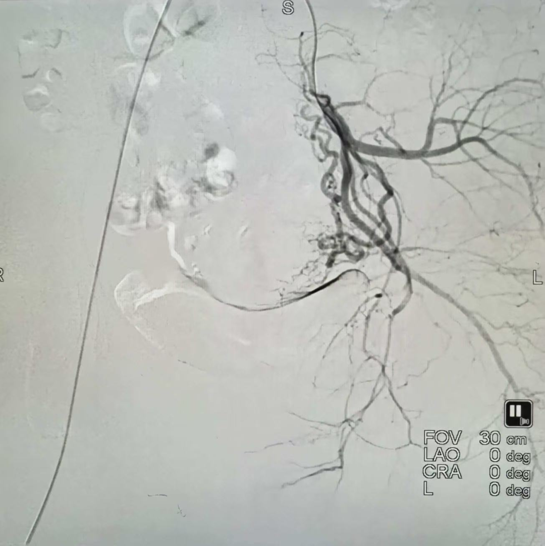 惊险！孕囊长在子宫「老伤疤」上，多学科联手度「瘢痕妊娠」生命危机