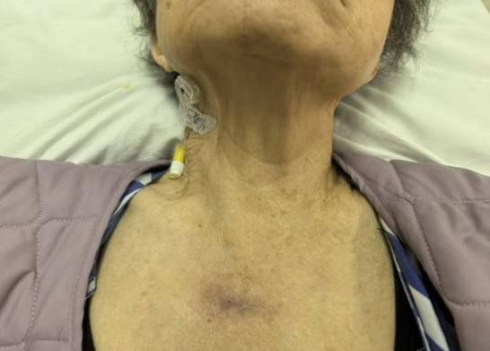 这种甲状腺癌一年生存率仅 20%！90 岁老太如何赢得生机？