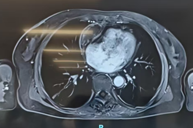 腹水缠身三载求医路尽 心脏巧解难题绝处逢生