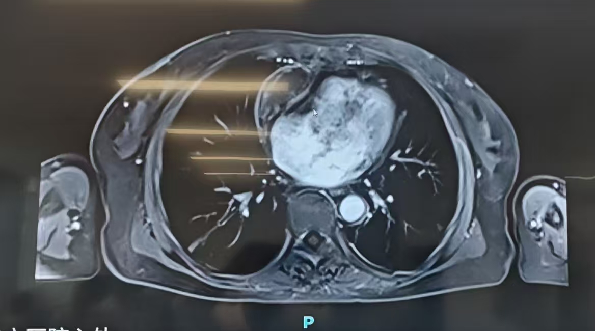 腹水缠身三载求医路尽 心脏巧解难题绝处逢生
