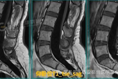 【高尚病例】腰椎 MRI 仰卧位与俯卧位检查技术在脊髓拴系综合征的应用