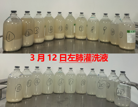 反复胸闷、咳嗽,双肺竟然洗出 40 余瓶脏水!