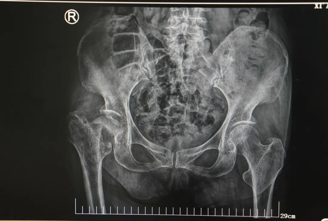 86 岁，当「人生最后一次骨折」遇上心脏 3 根血管堵了 2 根