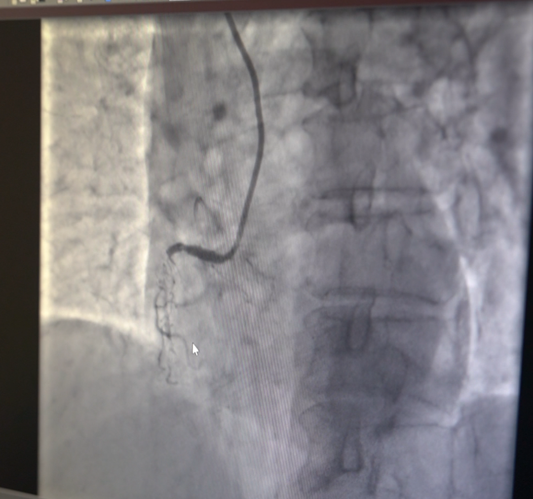 86 岁，当「人生最后一次骨折」遇上心脏 3 根血管堵了 2 根