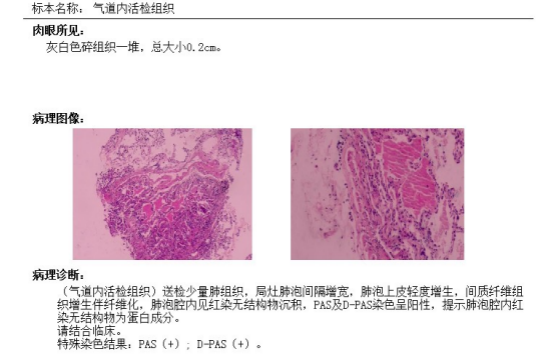 反复胸闷、咳嗽,双肺竟然洗出 40 余瓶脏水!